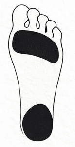Pied creux Degré 3